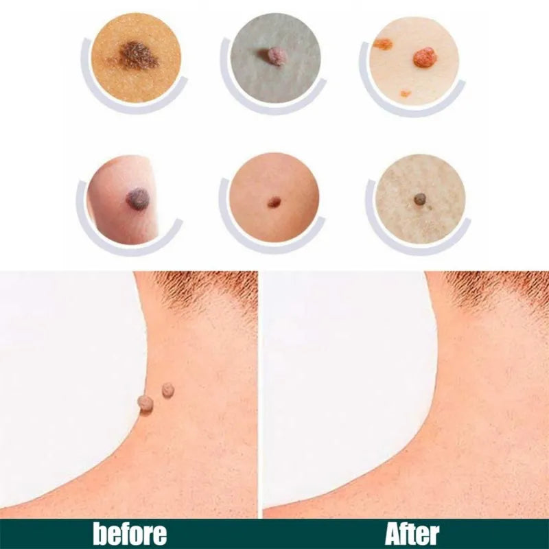 Facial verruga Tag removedor Patch, Acne Pimple Patches, Tag da pele, Mole adesivo, Reparação da pele, Antibacteriano Corn Plast, Cuidados com a pele, 120pcs