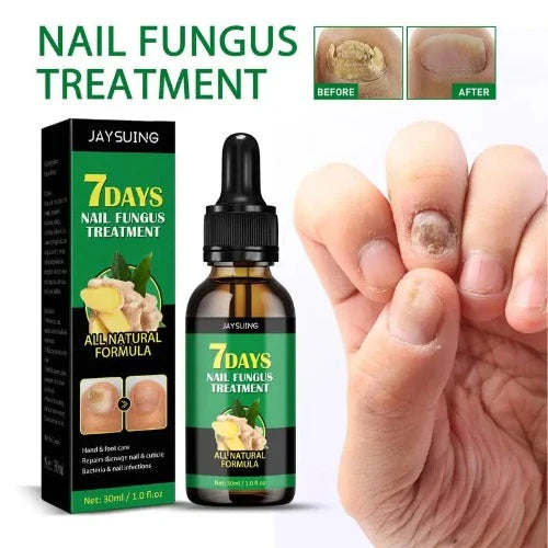 Funguss-Solução Unha Cuidado, Óleo De Paroníquia, Tratamento Unha Ingrown, Essência Reparação De Unhas, Feito com Gengibre