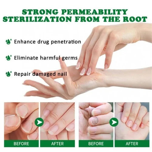 Funguss-Solução Unha Cuidado, Óleo De Paroníquia, Tratamento Unha Ingrown, Essência Reparação De Unhas, Feito com Gengibre